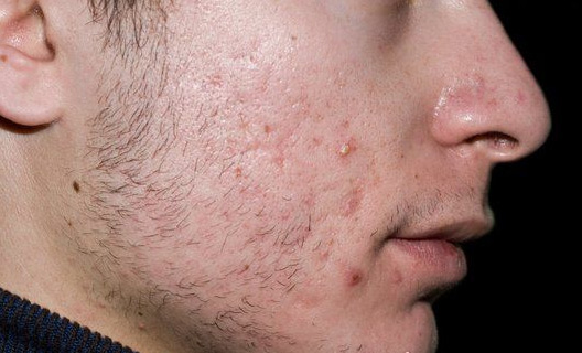 عواملی که جوش&zwnj;های پوست را زیاد می&zwnj;کنند