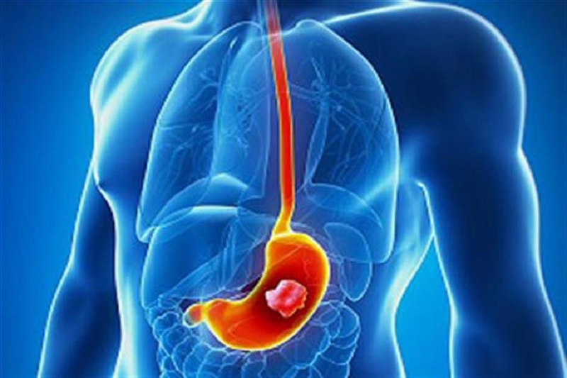 نشانه&zwnj;های زخم معده