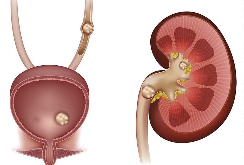 نوشیدنی ماءالشعیر سنگ کلیه میسازد! نوشیدنی ماءالشعیر سنگ کلیه میسازد!